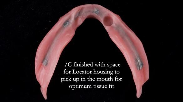 Managing poor implant positioning with complete dentures and Locator attachments - full protocol Newsletter 41
