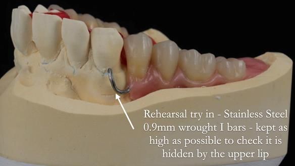 Newsletter 56 showing the making and fitting of a bilateral free end saddle upper removable partial denture (RPD) for patient with pemphigus