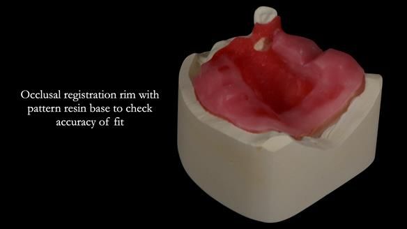 Newsletter 55 Provision of metal based partial dentures for Zephyrine with a repaired cleft lip and palate