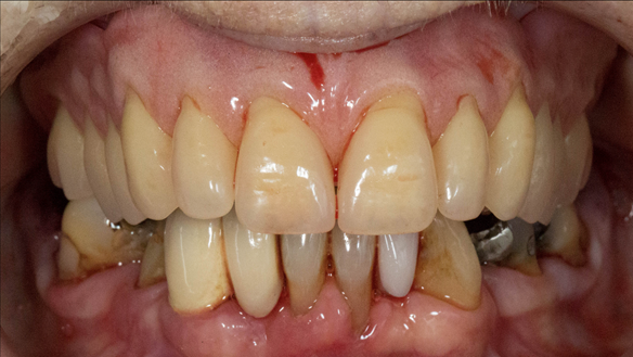 Figure 37 Immediate denture fitted straight after extracting the teeth