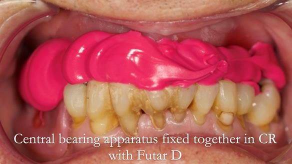 Newsletter 54 case presentation upper complete denture and lower Scandinavian designed hygienic partial denture for David
