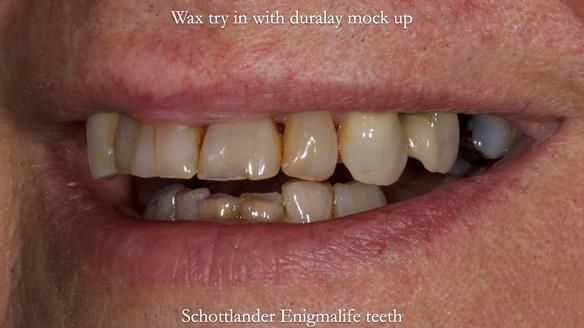 Finlay's Newsletter 64 case study - provision of a Kennedy class 2 metal based Scandinavian RPD for Ian