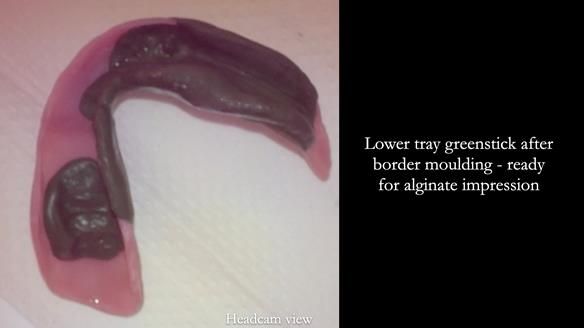 Newsletter 82 Mary - A complete upper and a one-tooth gasket denture