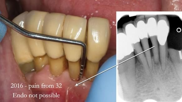 Ken – going downhill, first class