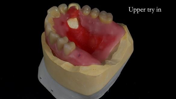 Newsletter 55 Provision of metal based partial dentures for Zephyrine with a repaired cleft lip and palate
