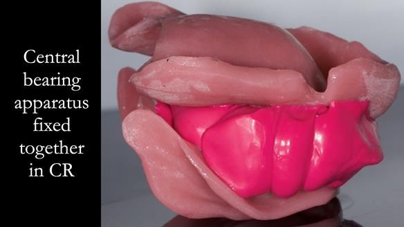 Complete denture Class II div 2 deep overbite Newsletter 39