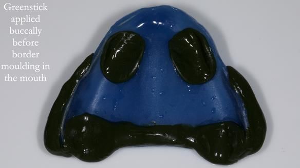 Newsletter 80 - Gordon’s dentures: the one case in 1,000 where my technique failed