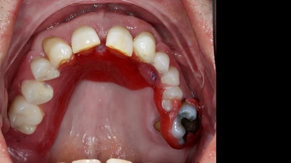 Newsletter 86 Peter the Architect — precision removable partial dentures case study