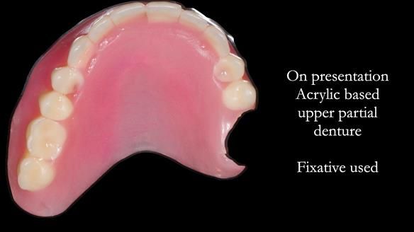 Finlay's Newsletter 58 Gasket upper partial denture for Zoe