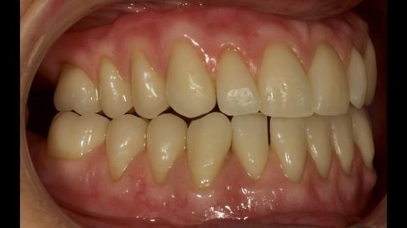 Finished dentures - mimicking Mary’s daughters natural teeth