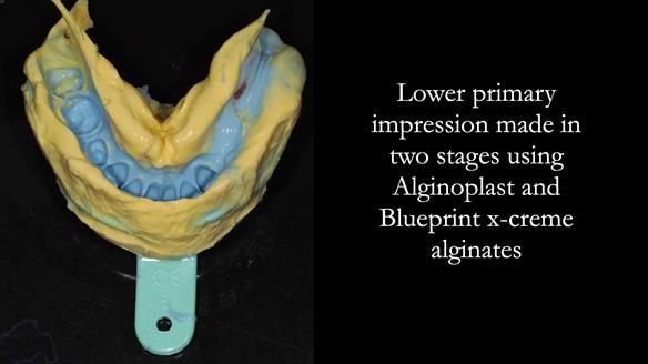 Finlay's Newsletter 61 provision of a lower unilateral free end saddle metal based partial denture for Joyce