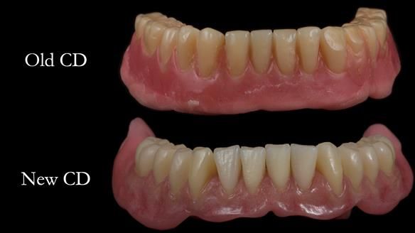 Finlay's Newsletter 62 provision of extractions and metal based complete dentures for Rafique