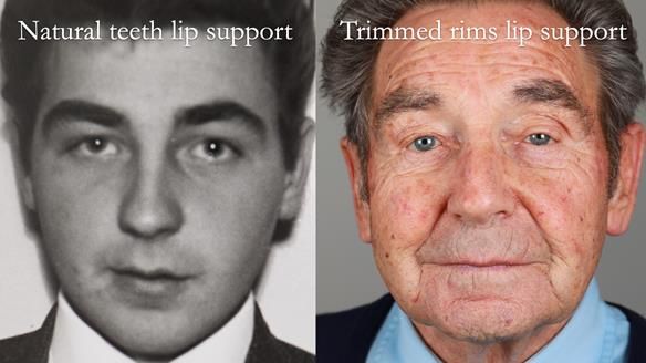 Newsletter 50 Special edition Complete Dentures FULL PROTOCOL