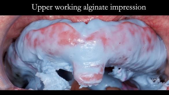 Complete denture Class II div 2 deep overbite Newsletter 39