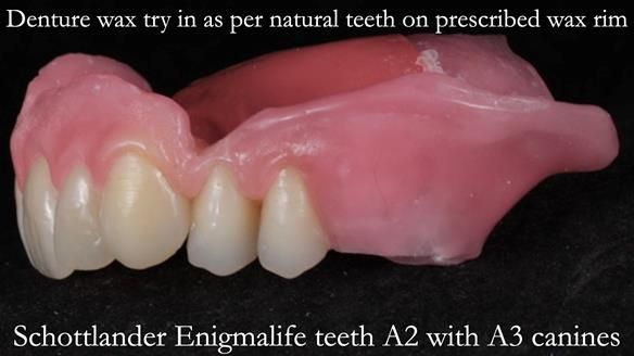 Finlay's Newsletter 58 Gasket upper partial denture for Zoe