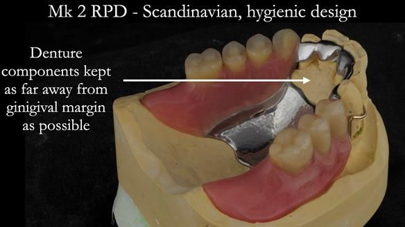 Finlay's Case Study Newsletter 40 - Immediate Mk 1 RPD to Definitive Mk 2 RPD - full protocol