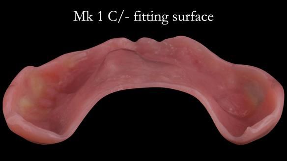 Newsletter 52 Managing Jo’s failing dentition with extractions and Mk 1/Mk 2 complete upper dentures and lower partial dentures FULL PROTOCOL