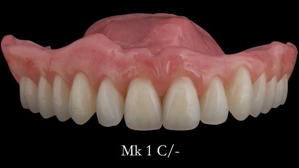 Newsletter 52 Managing Jo’s failing dentition with extractions and Mk 1/Mk 2 complete upper dentures and lower partial dentures FULL PROTOCOL