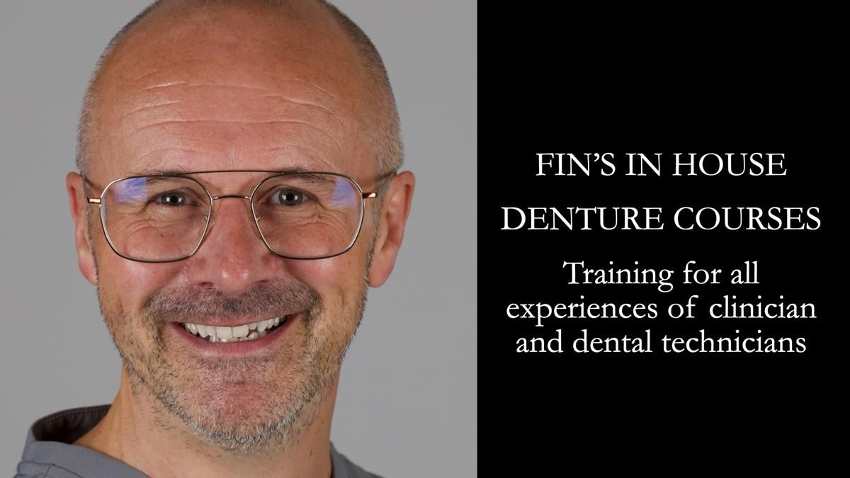 Newsletter 89 – Simon: A Challenging Kennedy Class II Division 1 Upper CoCr Partial Denture with a High Smile Line