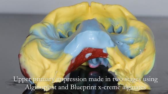 Finlay's Newsletter 60 Sylvia's upper Kennedy Class 2 Mod 1 metal based upper RPD