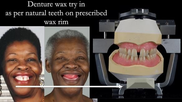 Newsletter 53 showing the making and fitting of ultra life-like dentures for Valena