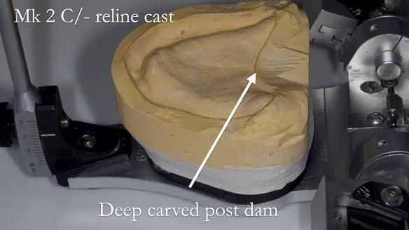 Replacing Madeline’s Complete denture FULL PROTOCOL