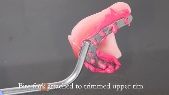 Newsletter 54 case presentation upper complete denture and lower Scandinavian designed hygienic partial denture for David