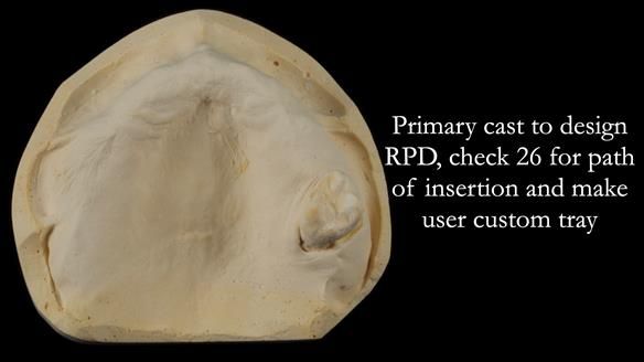 Finlay's Newsletter 58 Gasket upper partial denture for Zoe