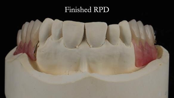 Finlay's Newsletter 60 Sylvia's upper Kennedy Class 2 Mod 1 metal based upper RPD