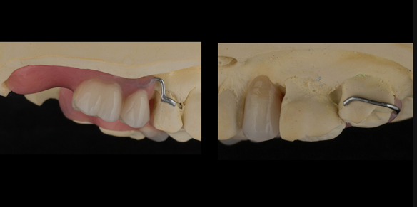 Figure 25 Mounted working cast for Mk 1 immediate denture. Teeth removed from cast - minimal preparation of the cast to reduce adjustments at fit