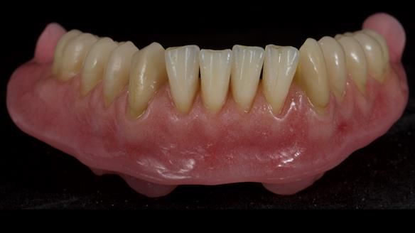 Newsletter 80 - Gordon’s dentures: the one case in 1,000 where my technique failed