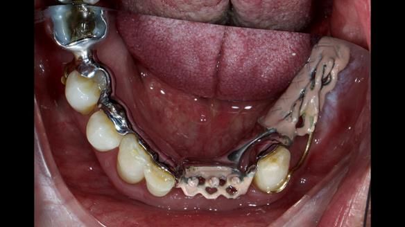Newsletter 86 Peter the Architect — precision removable partial dentures case study