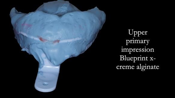 Newsletter 52 Managing Jo’s failing dentition with extractions and Mk 1/Mk 2 complete upper dentures and lower partial dentures FULL PROTOCOL