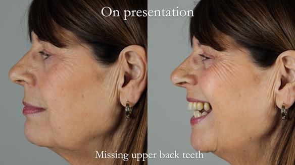 Newsletter 56 showing the making and fitting of a bilateral free end saddle upper removable partial denture (RPD) for patient with pemphigus