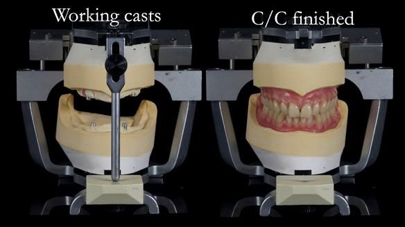 Newsletter 57 showcases the making and fitting process of implant-supported complete dentures for Alisdair