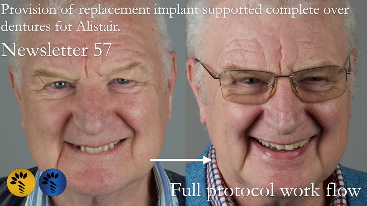 Treatment of Alisdair - Full protocol - provision of implant supported metal based complete dentures
