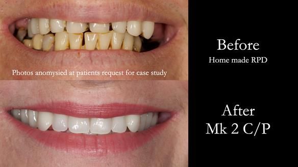 Newsletter 52 Managing Jo’s failing dentition with extractions and Mk 1/Mk 2 complete upper dentures and lower partial dentures FULL PROTOCOL