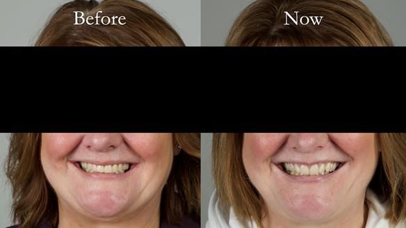 Finlay's Newsletter 58 Gasket upper partial denture for Zoe