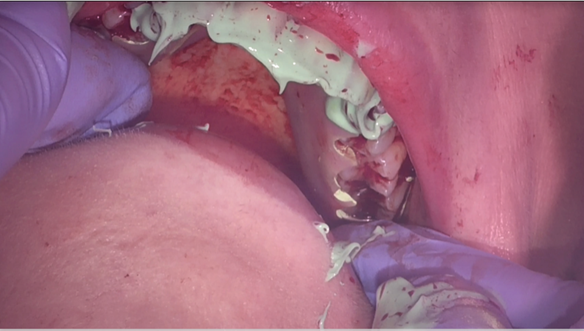 Figure 32 Seating the immediate denture to check the fit with light bodied silicone and Occlude spray