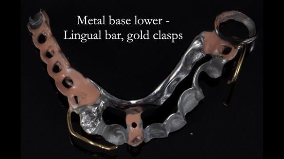 Newsletter 55 Provision of metal based partial dentures for Zephyrine with a repaired cleft lip and palate