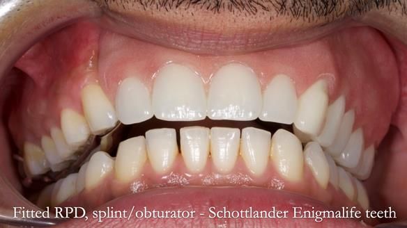 Upper metal base partial denture/occlusal stabilisation splint/obturator - full protocol
