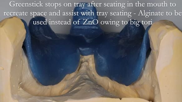 Newsletter 53 showing the making and fitting of ultra life-like dentures for Valena