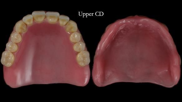Newsletter 83: Sheila’s Complete Denture Success