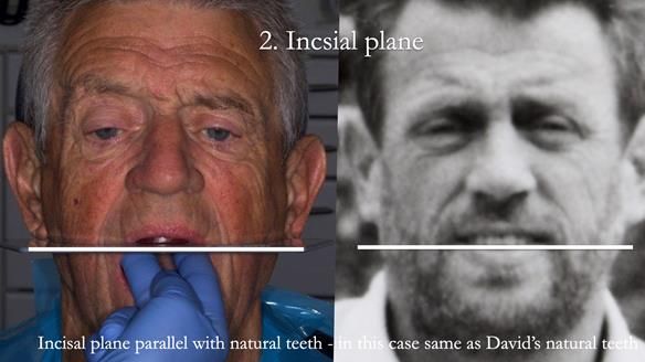 Newsletter 54 case presentation upper complete denture and lower Scandinavian designed hygienic partial denture for David