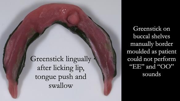 Managing poor implant positioning with complete dentures and Locator attachments - full protocol Newsletter 41