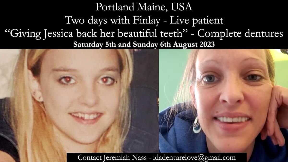Newsletter 51 Managing Anne’s failing dentition with distal extension base RPD/Splint FULL PROTOCOL
