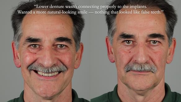 Newsletter 78: What do Clark Gable and a Locator® overdenture have in common?