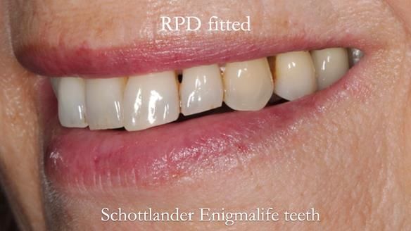 Newsletter 56 showing the making and fitting of a bilateral free end saddle upper removable partial denture (RPD) for patient with pemphigus