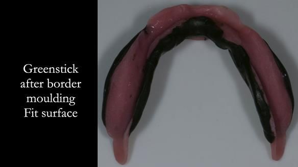 Newsletter 75: Marion’s case - Step-by-step complete denture workflow