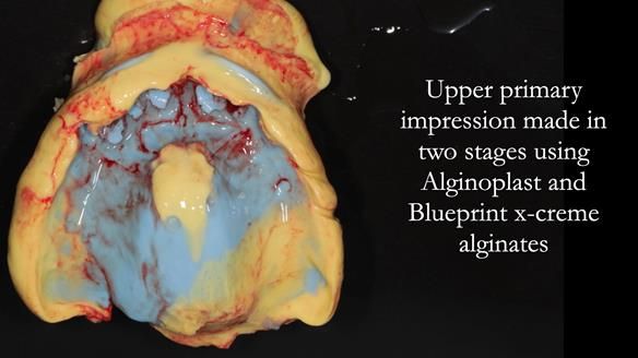 Finlay's Newsletter 62 provision of extractions and metal based complete dentures for Rafique